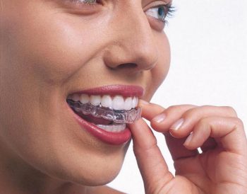 Proste zęby dzięki masce i bez „drutów”? - Szyna Invisalign